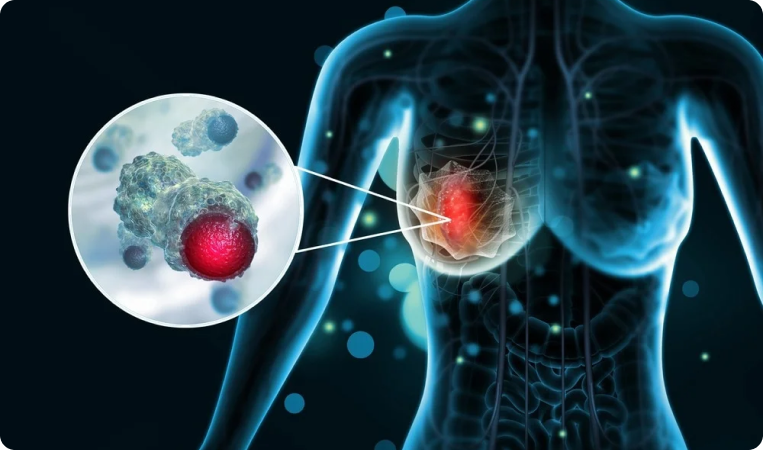 Randomized Control Trial on Fractionation Schedules in Breast Malignancy