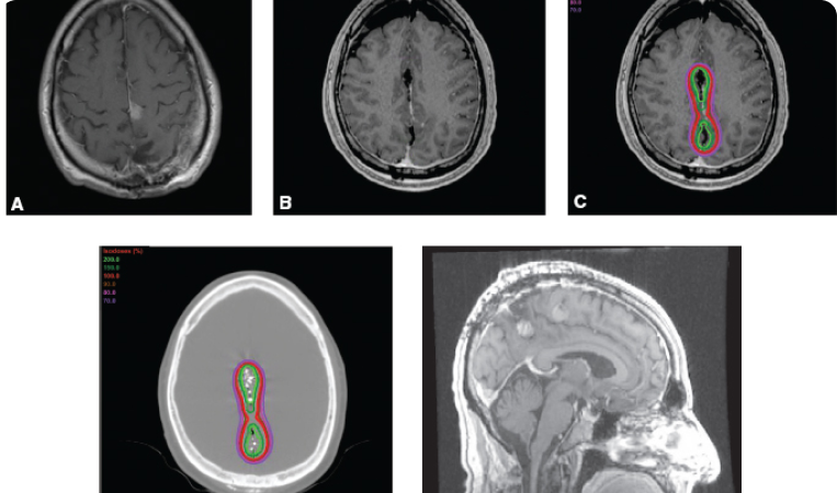 Exploring the Radiobiology of Brachytherapy